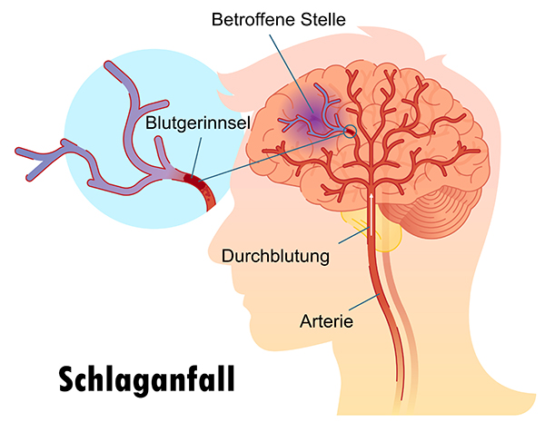 Schlaganfallrisikos