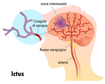 ictus