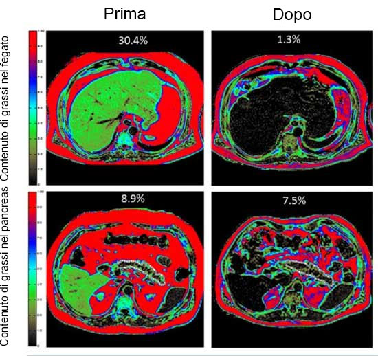 Fegato e pancreas, prima e dopo la perdita di peso