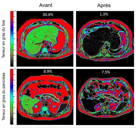Foie et pancréas, avant et après la perte de poids