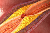 Representación de la aterosclerosis 