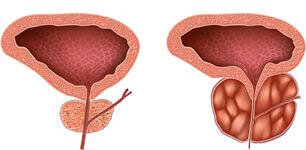 traitement adenome prostate plantes)